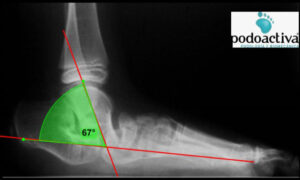 pie en balancín o astrágalo vertical congénito aislado (AVC)