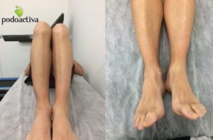 Dismetría Podoactiva