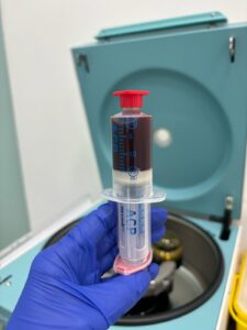 infiltracion plasma rico en plaquetas