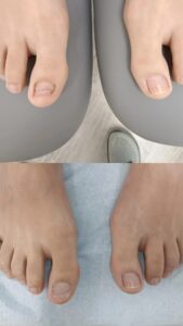 reconstruccion ungueal