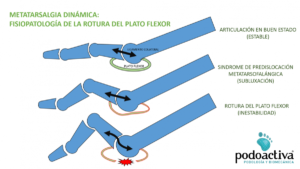 síndrome predislocacion metatarsalgia (3)