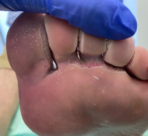 queratolisis punctata