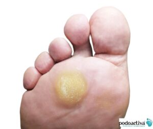 callos y durezas en los pies