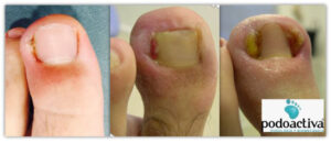 uña incarnada ejemplo