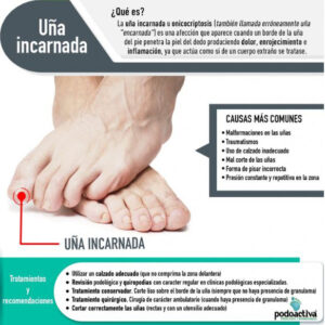 uña incarnada que es