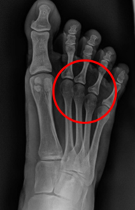 Radiografía de paciente con separador de dedos