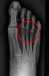 Radiografía de paciente sin separador de dedos