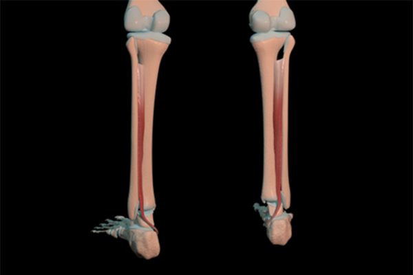 tibial posterior