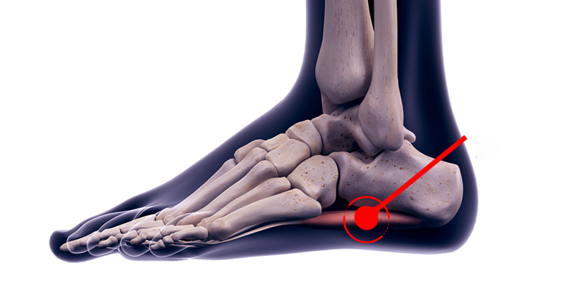 fibroma plantar