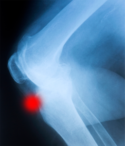 Enfermedad de Osgood Schlatter