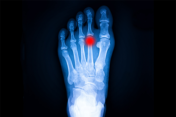 enfermedad de freiberg