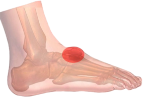 quiste sinovial podoactiva