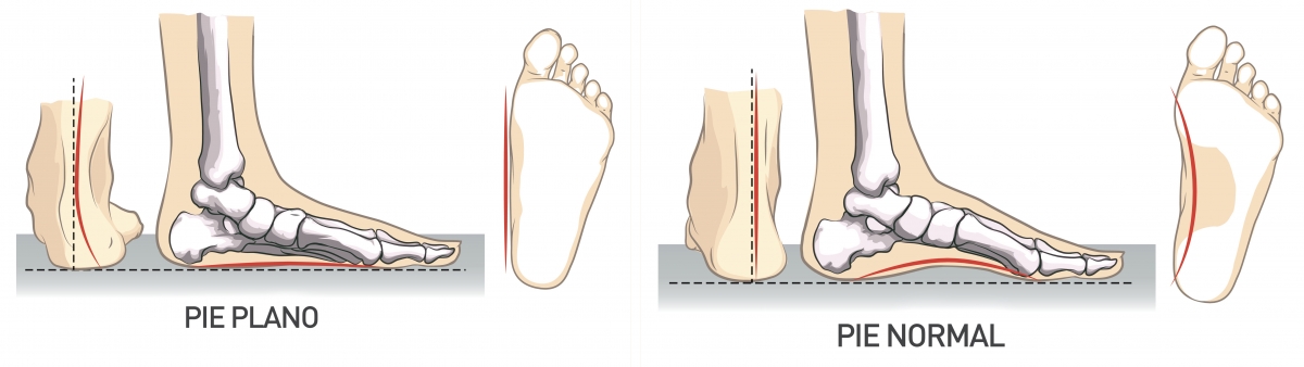 pies planos y pìe con arco