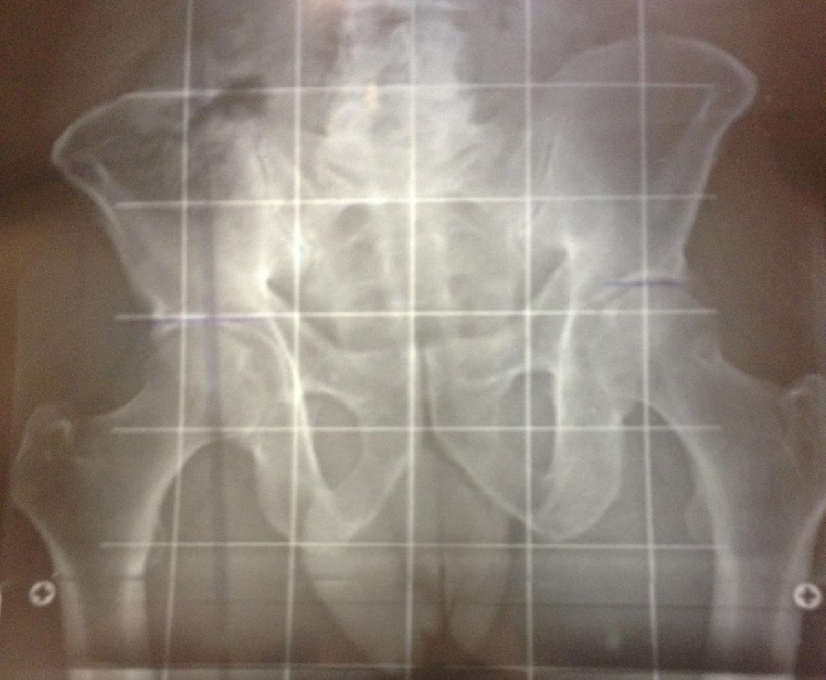 Dismetría de cadera